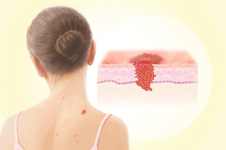 با وجود آن‌که ملانوم یکی از علل اصلی مرگ‌و‌میر ناشی از بیماری‌های پوستی به شمار می‌رود، درصورت تشخیص زودهنگام قابل‌ درمان خواهد بود.